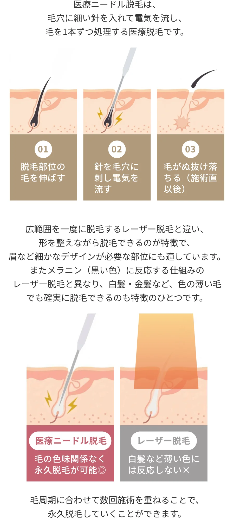 医療ニードル脱毛は、毛穴に細い針を入れて電気を流し、毛を1本ずつ処理する医療脱毛です。広範囲を一度に脱毛するレーザー脱毛と違い、形を整えながら脱毛できるのが特徴で、眉など細かなデザインが必要な部位にも適しています。毛周期に合わせて数回施術を重ねることで、永久脱毛していくことができます。